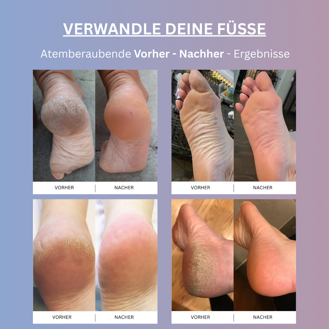 Samtfuss Pro - Elektrischer Hornhautentferner